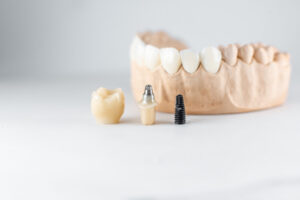 Everything You Should Know About Dental Implants in Logan UT