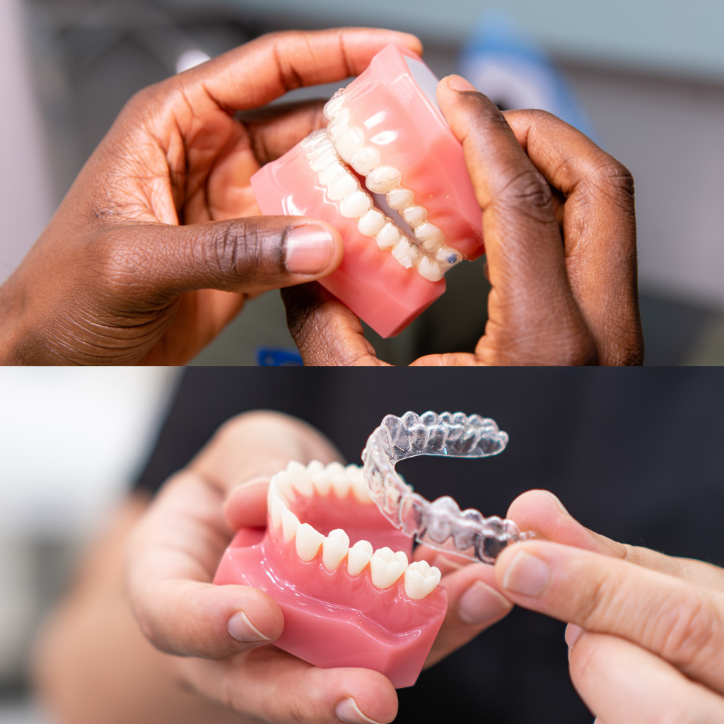 3D digital oral scanner capturing teeth alignment for clear aligners