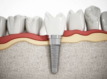 dental implant bone graft